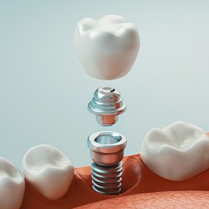 a graphic model showing the different parts of a dental implant