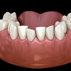 Illustration of crooked teeth