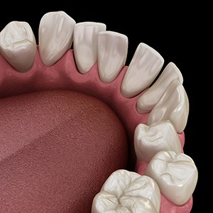 Illustration of gapped teeth