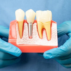 Gloved hands holding dental implant model