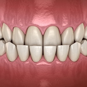 Illustration of an underbite