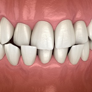 Illustration of a crossbite