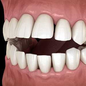 Illustration of an open bite