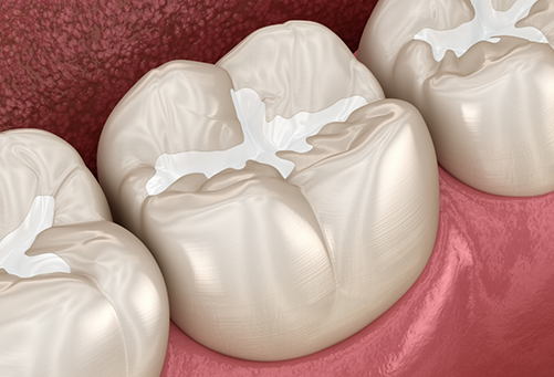 Illustration of teeth in lower arch with dental sealants