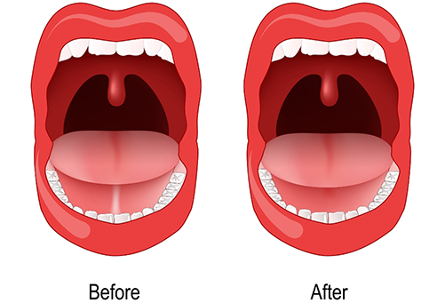 Illustration of open mouth before and after frenectomy