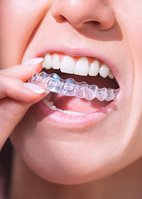 Close up of woman about to wear clear aligner in Plano