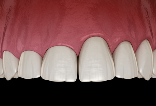 Illustration of upper arch of teeth with uneven gumline