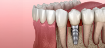 Illustration of dental implant in lower jawbone