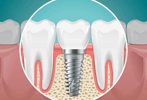 Illustration of dental implant between two teeth