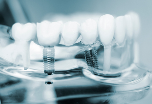 Dental implants in plastic model of mouth