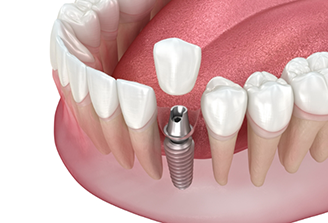 Illustration of dental crown being attached to a dental implant