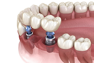 Illustration of dental bridge being anchored to dental implants