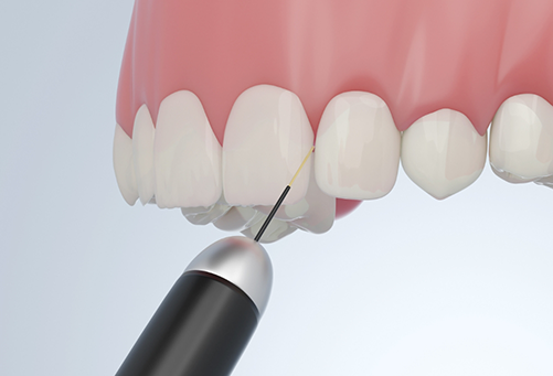 Using soft tissue laser to treat gums