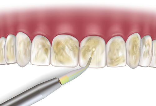 Illustration of laser used for periodontal therapy