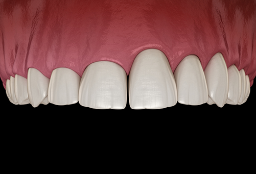 Illustration of upper arch of teeth with uneven gumline