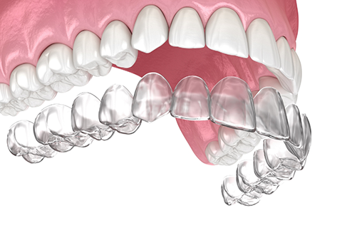 Clear aligners about to be placed on upper teeth