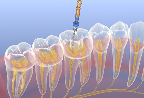 Illustration of root canal treatment in lower arch