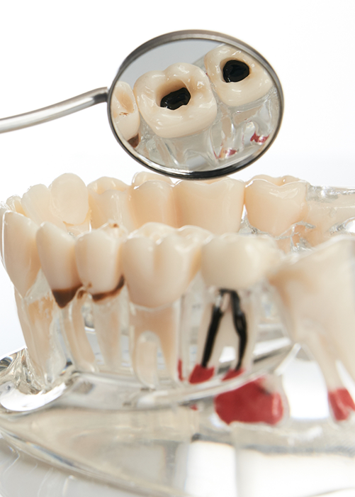 Model of decayed teeth being examined by dental mirror