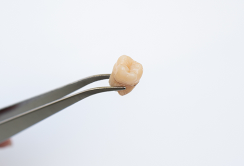 Tooth held between metal forceps