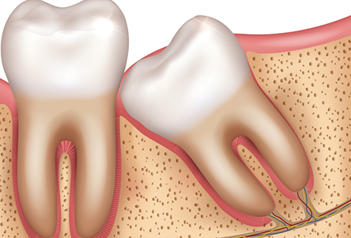 Illustration of impacted wisdom tooth leaning against other tooth
